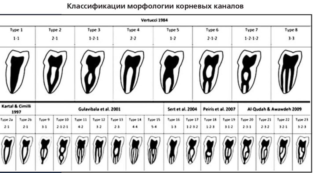 Классификации морфологии корневых каналов