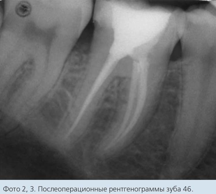 Фото 2, 3. Послеоперационные рентгенограммы зуба 46.