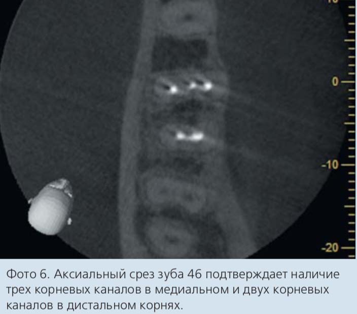 Фото 6. Аксиальный срез зуба 46 подтверждает наличие трех корневых каналов в медиальном и двух корневых каналов в дистальном корнях.