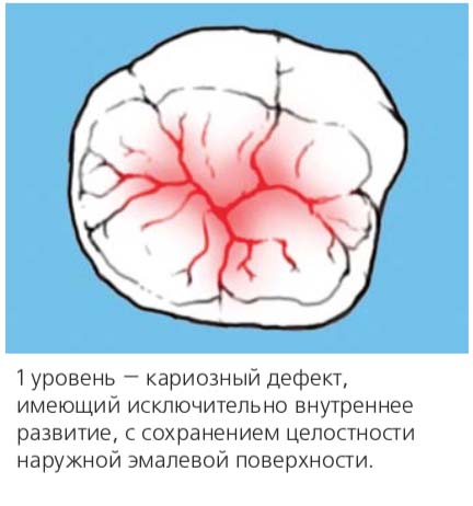 1 уровень — кариозный дефект