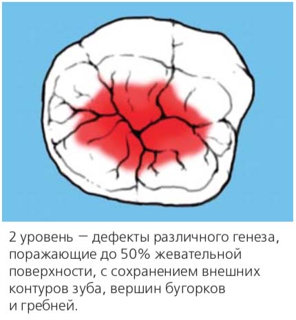 2 уровень — дефекты различного генеза, поражающие до 50% жевательной поверхности