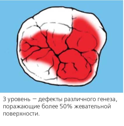 3 уровень — дефекты различного генеза, поражающие более 50% жевательной поверхности.